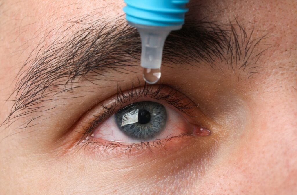 Close up of a man's red, dry eye with an artificial tears bottle dripping a drop into his eye.