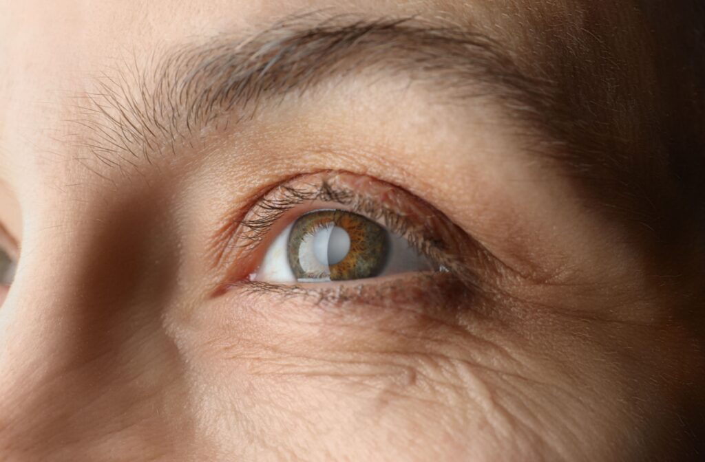 A close-up of an older adult's eye that has become clouded due to cataracts.