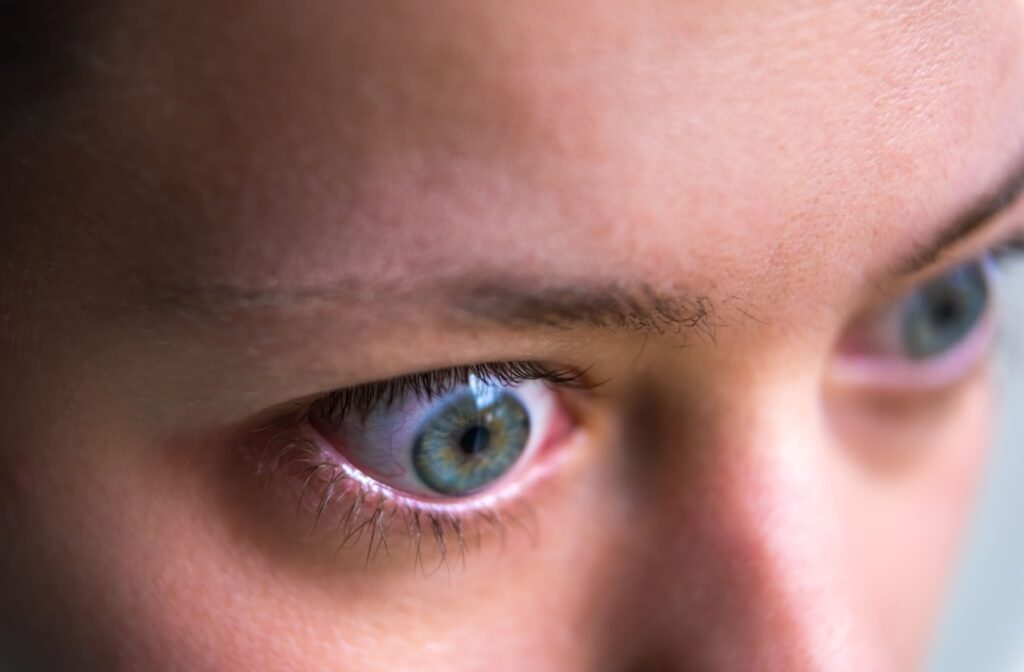 Close-up of a patient’s blue-green eyes, bulging slightly as a result of Graves’ eye disease.