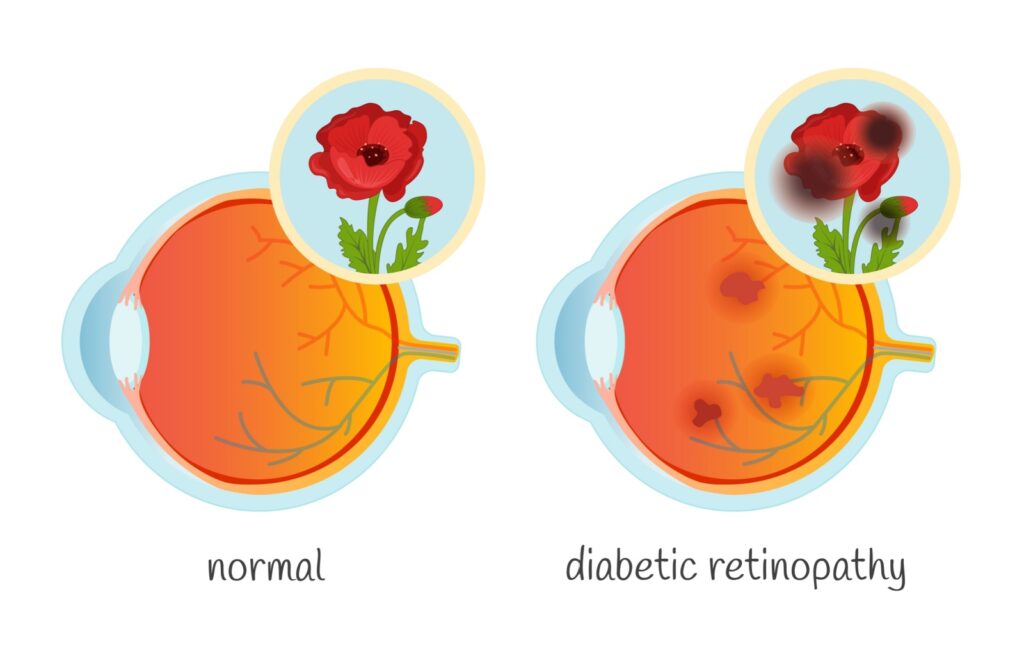 Cross section diagram of healthy eye and eye with diabetic retinopathy. Normal eye has clear vision of a flower, and retinopathic eye has spots from hemorrhage.