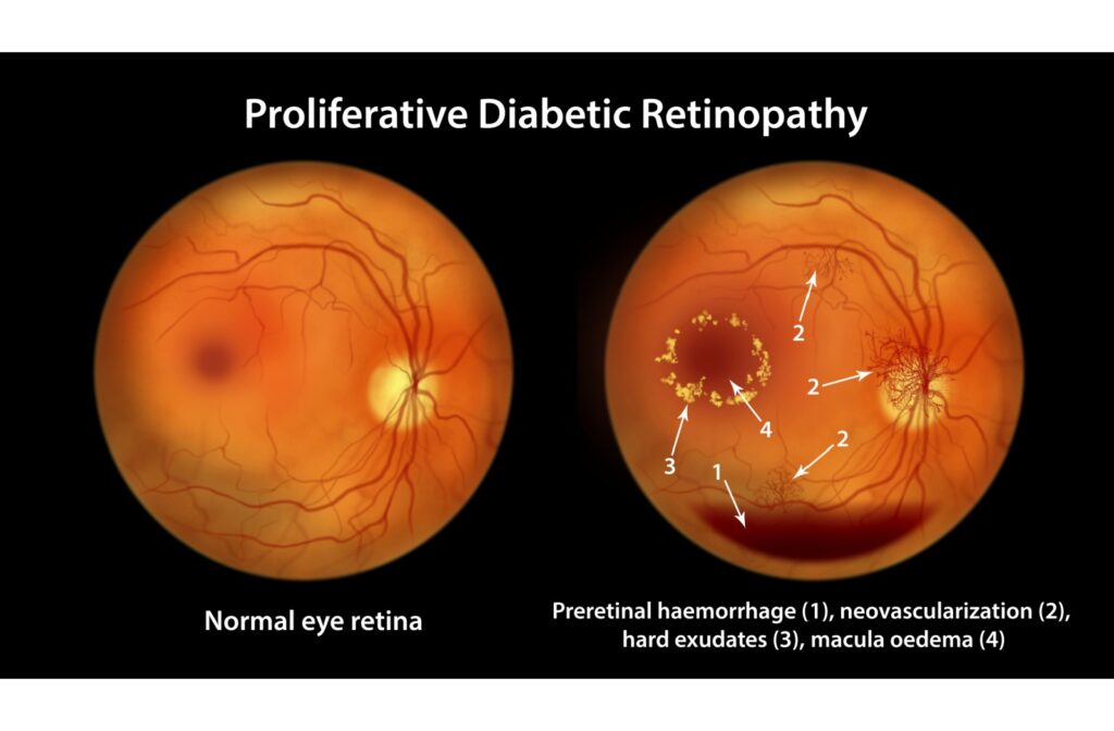 retinal image of normal and eye with retinopathy showing hemorrhages.