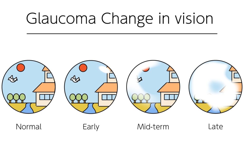 Diagram showing progressive glaucoma vision loss from normal, to early, midterm, and late.