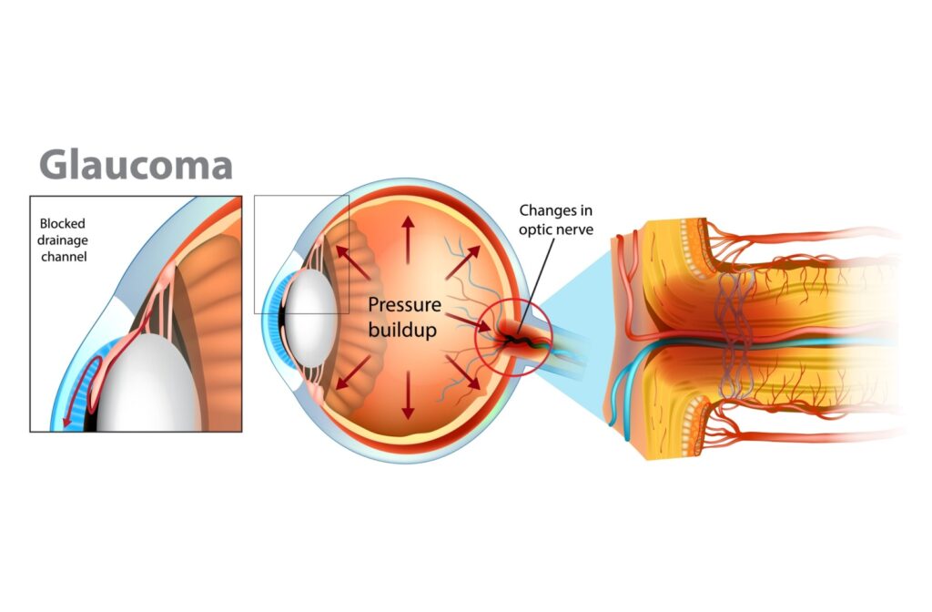 Cross section diagram of eye with glaucoma showing pressure build up, blocked drainage channel, and optic nerve damage.