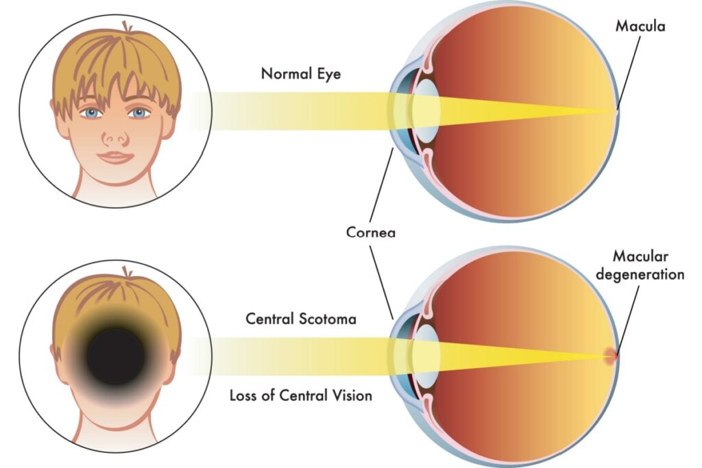Medical diagram comparing normal eye anatomy and vision with macular degeneration showing central scotoma and loss of central vision.
