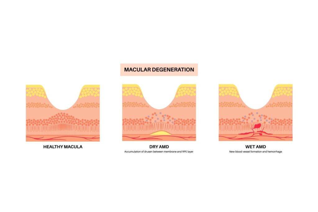 Medical diagram comparing healthy macula, dry AMD with drusen accumulation, and wet AMD with new blood vessel formation and hemorrhage.